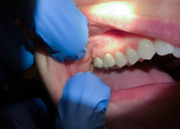 Best Emergency Denture Repair in Dunwoody, GA